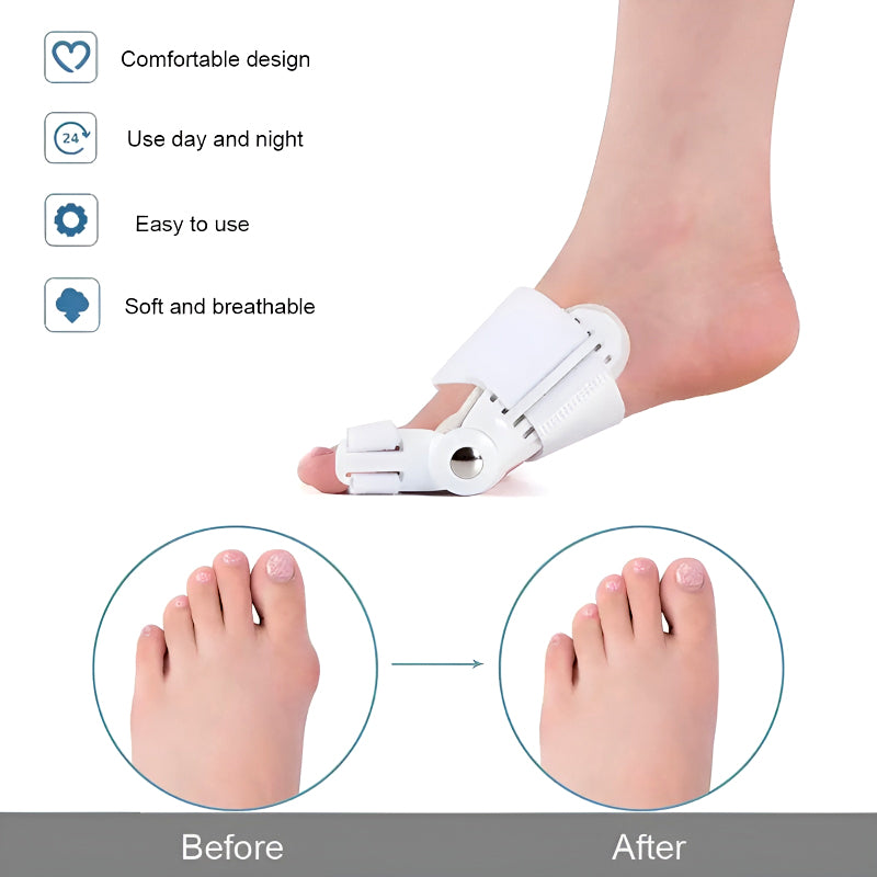 Bunion Splint and Big Toe Straightener – Orthopedic Hallux Valgus Corrector for Foot Pain Relief & Pedicure Care - Trendigo
